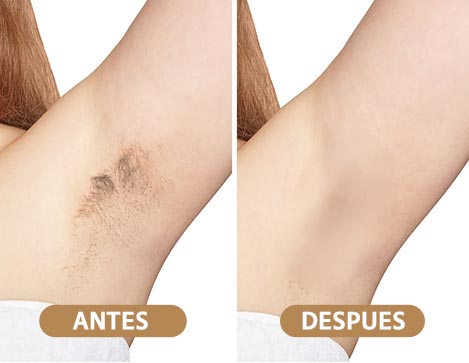 Imagen que muestra que una persona esta utilizando la depiladora láser Bye Bye IPL